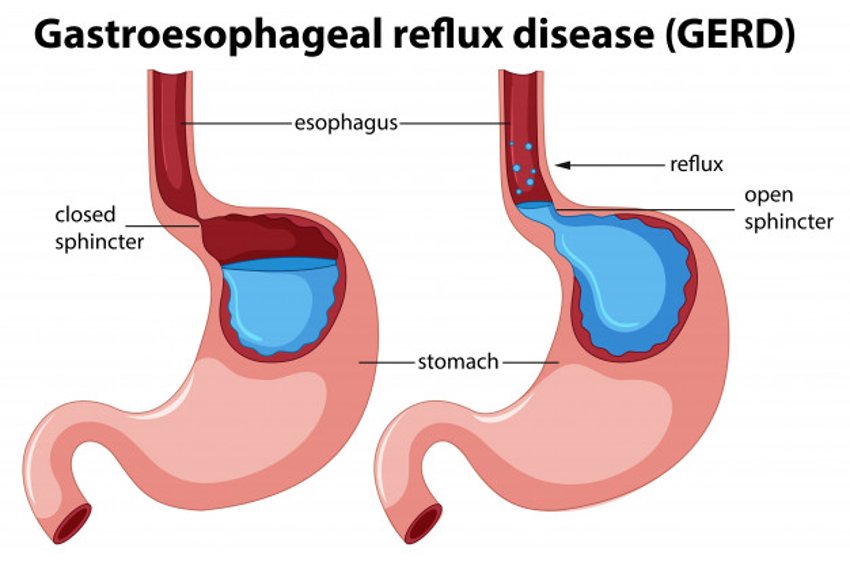 reflusso-gastro-esofageo